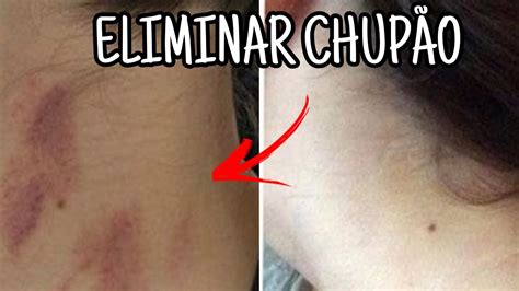 como tirsr chupao|Como tirar chupão: 8 truques simples para remover。